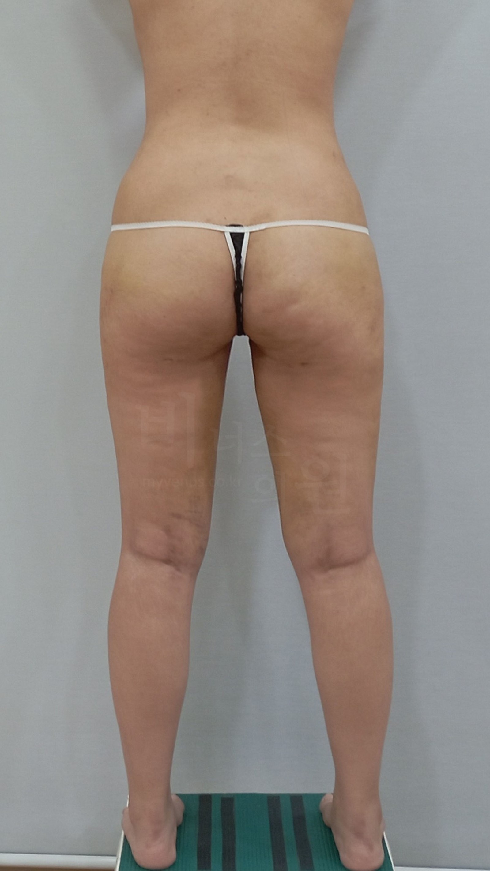 大腿与臀部肿胀吸脂术后1周背面
