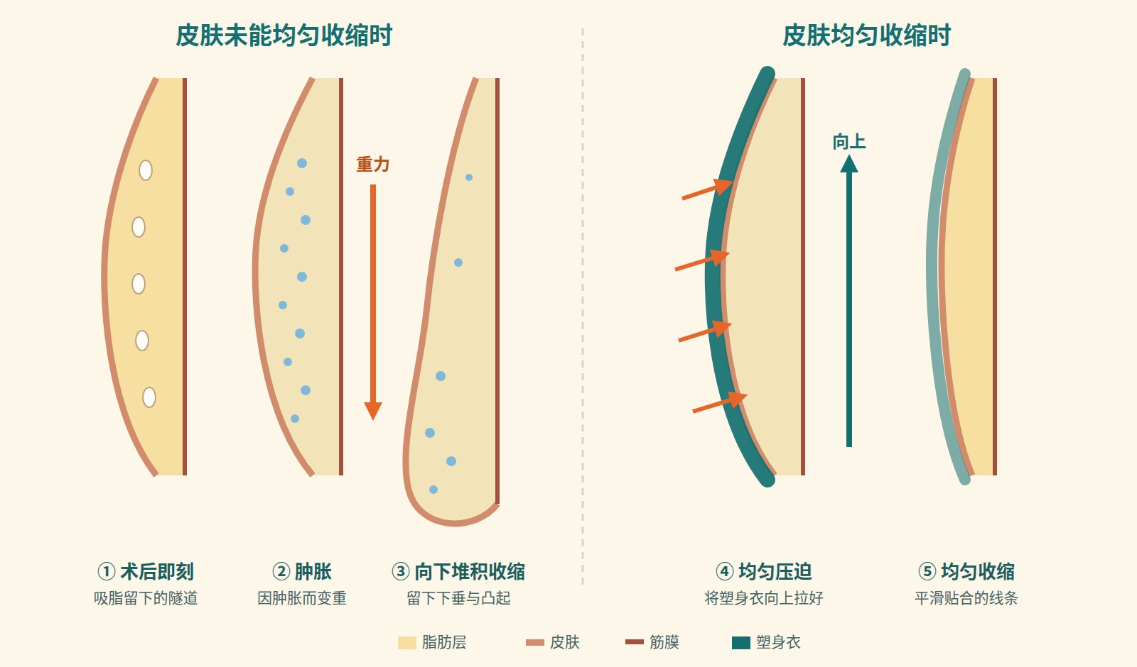 表示皮肤未能均匀收缩时留下下垂与凸起的过程，以及用塑身衣均匀压迫使皮肤均匀收缩的过程的断面图解