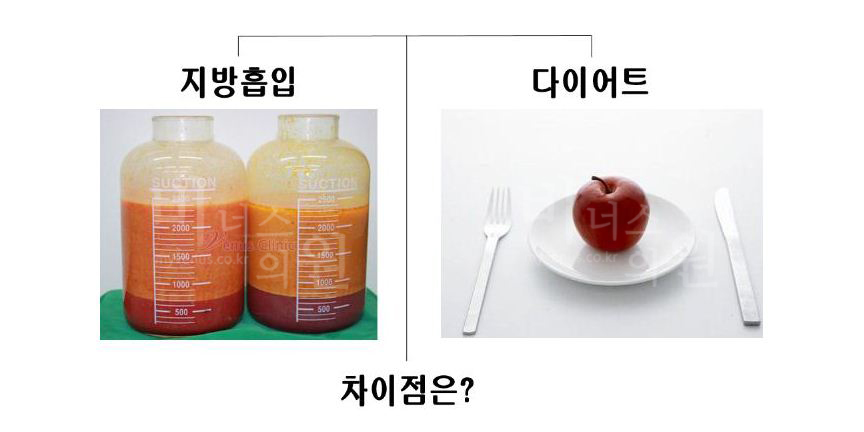 吸脂 vs 节食减肥
