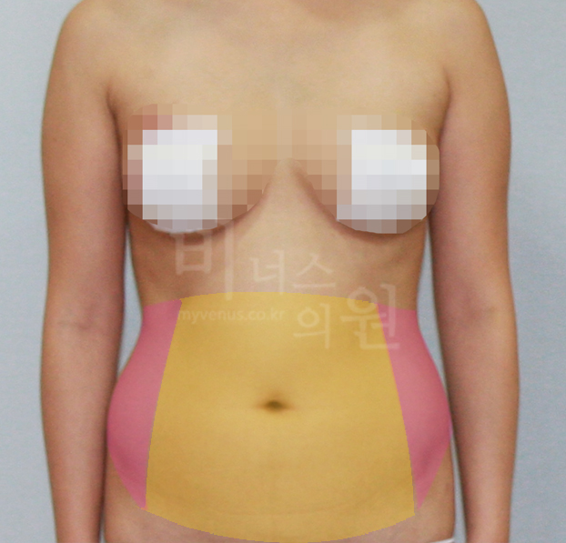 maximum liposuction of abdomen1.jpg