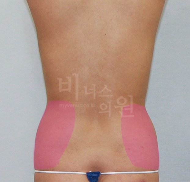 maximum liposuction of abdomen3.jpg