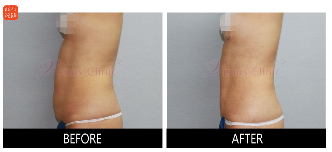 case1_abdomen_maximer2.jpg