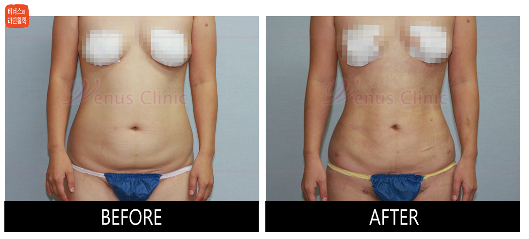 case2_abdomen_maximer1.jpg