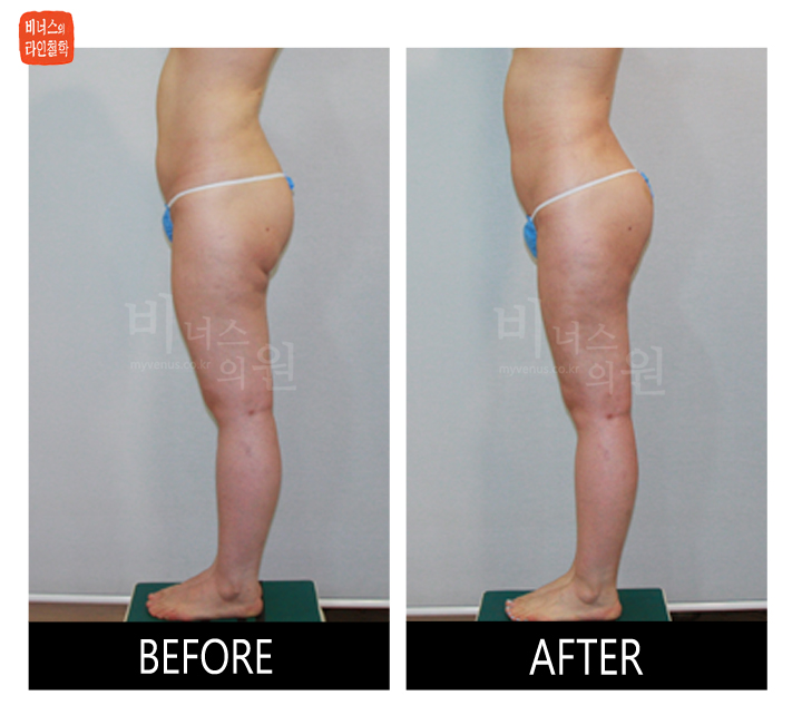 liposuction for buttocks ptosis and double banana fold5_.jpg