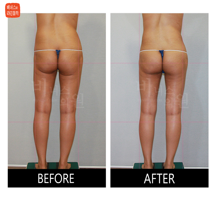liposuction for buttocks ptosis and double banana fold3.jpg