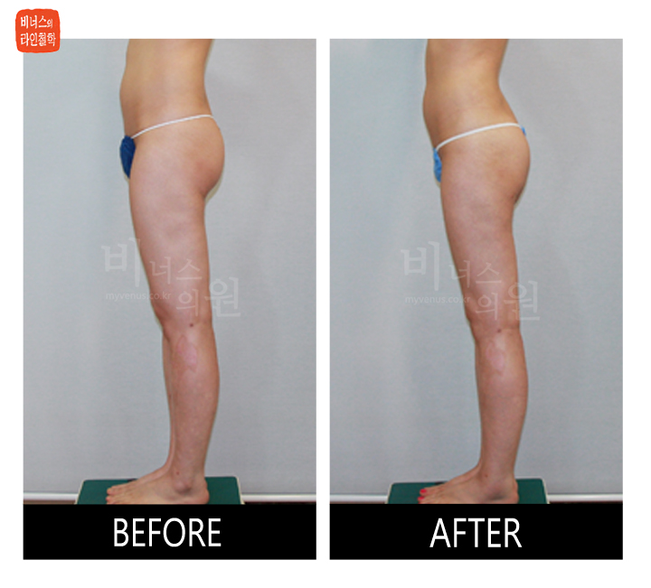 reoperation liposuction of buttocks6_.jpg