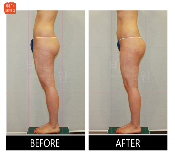 liposuction for buttocks ptosis and reoperation2.jpg