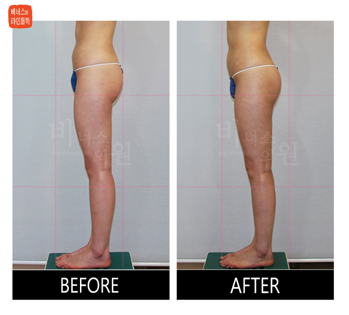 liposuction for buttocks ptosis and reoperation4.jpg