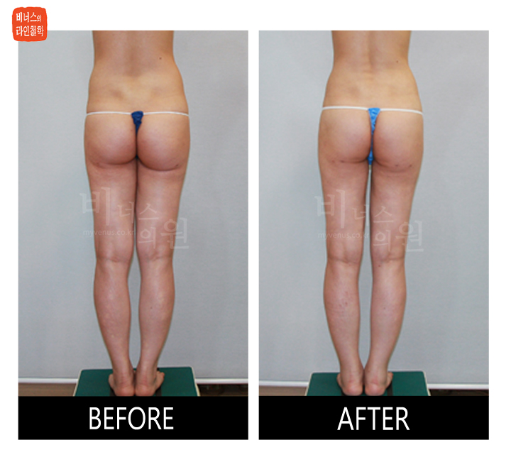 reoperation liposuction of buttocks6.jpg