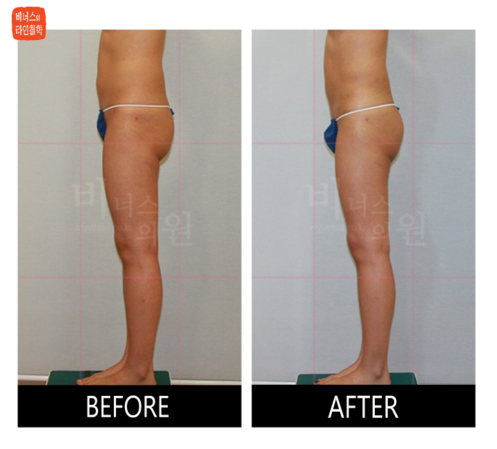 liposuction for buttocks ptosis and double banana fold4.jpg