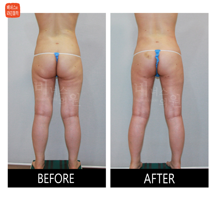 liposuction for buttocks ptosis and double banana fold5.jpg