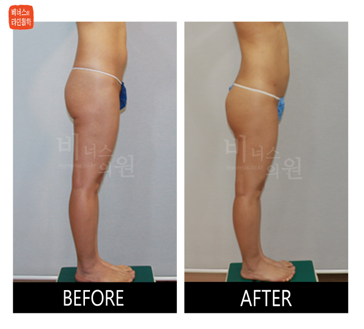 liposuction for buttocks ptosis and Love handles3_.jpg
