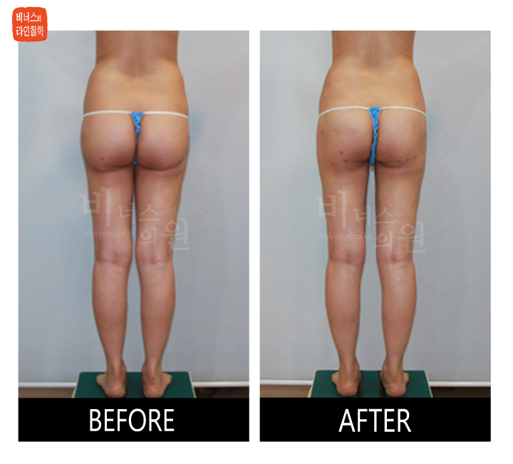 liposuction for buttocks ptosis and Love handles4.jpg