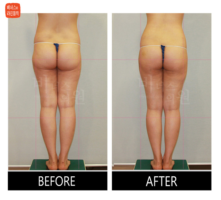 liposuction for buttocks ptosis and reoperation1