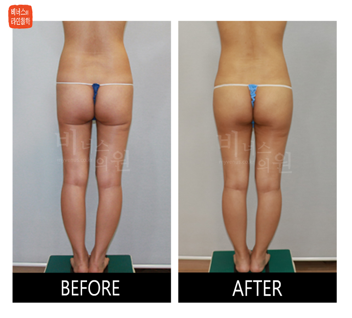 liposuction for buttocks ptosis and Love handles3.jpg