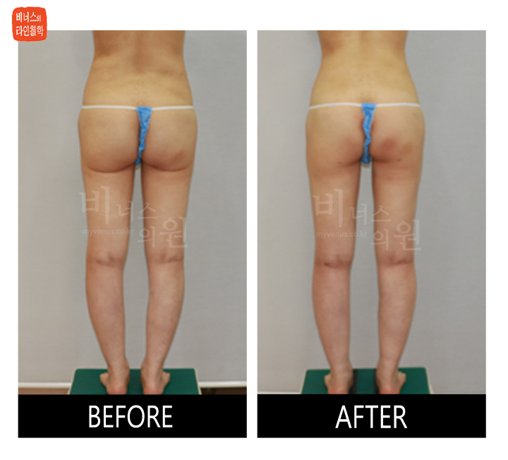 liposuction for buttocks ptosis and Love handles2.jpg