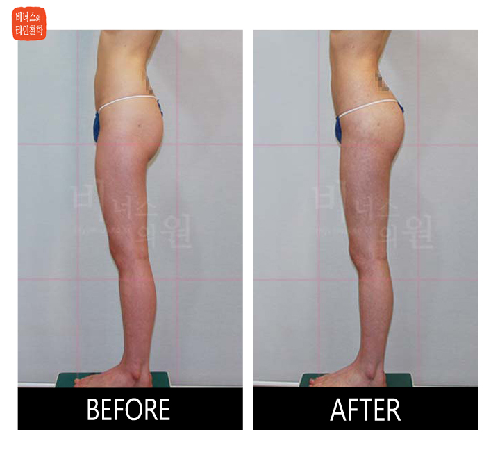 liposuction for buttocks ptosis and double banana fold2.jpg