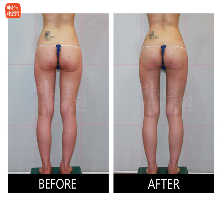 liposuction for buttocks ptosis and double banana fold1.jpg