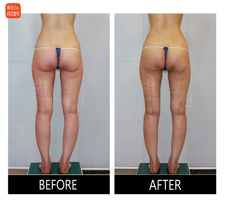 liposuction for buttocks ptosis and reoperation3.jpg