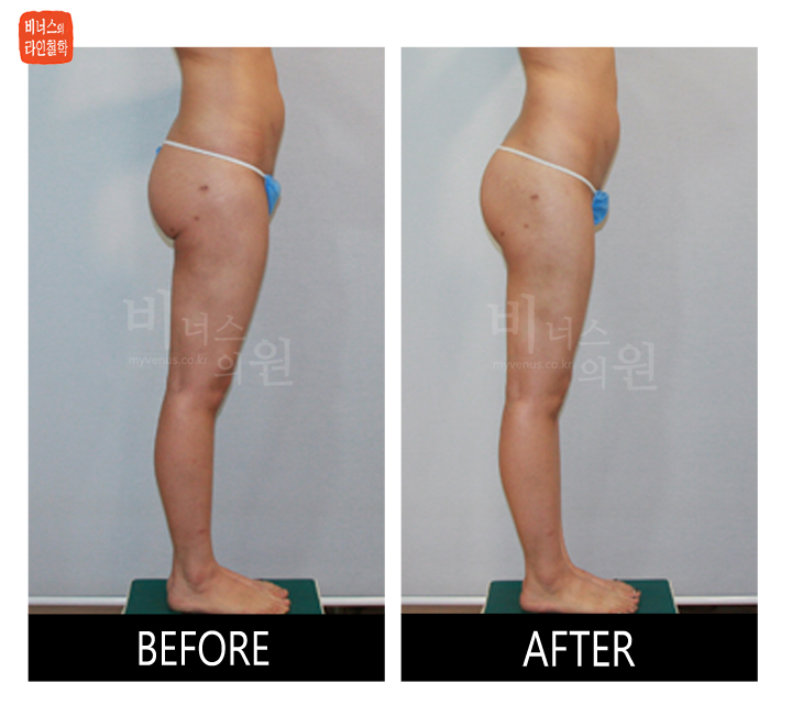 liposuction for buttocks ptosis and Love handles4_1.jpg
