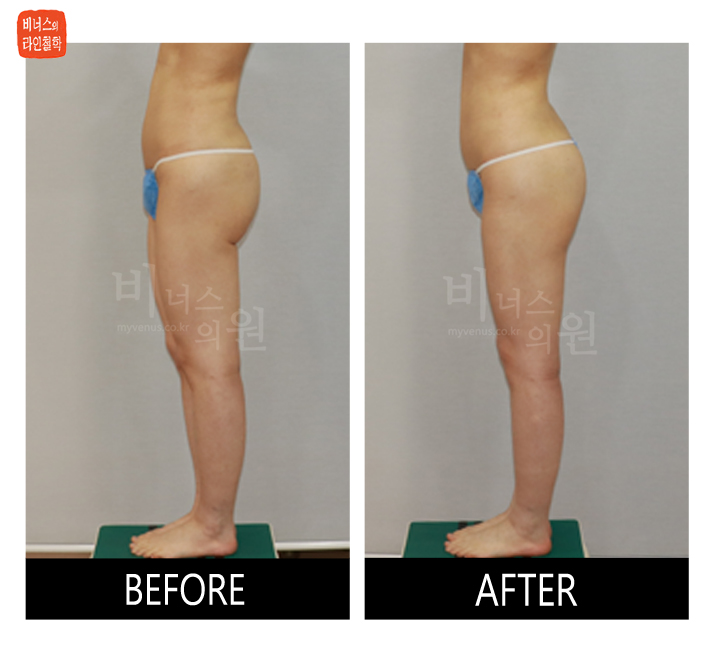 liposuction for buttocks ptosis and Love handles2_1.jpg