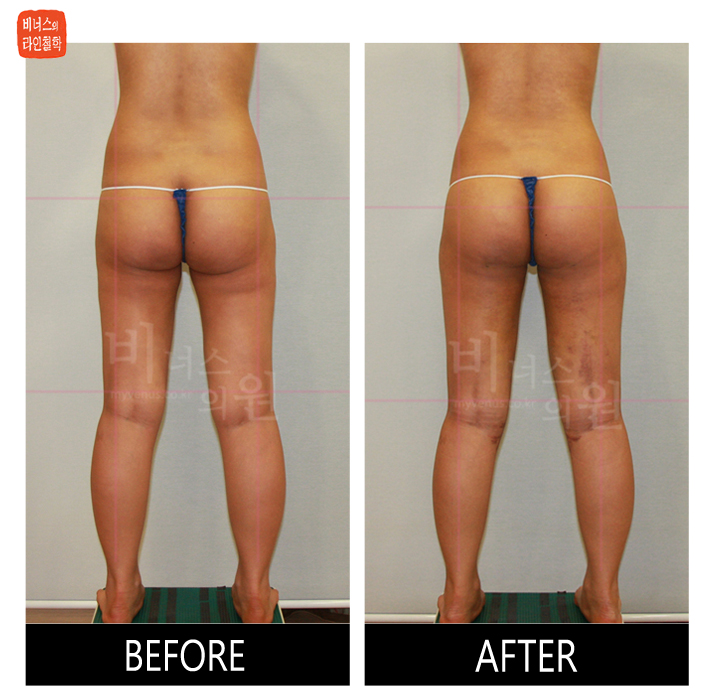 reoperation liposuction of thighs and buttocks_6.jpg
