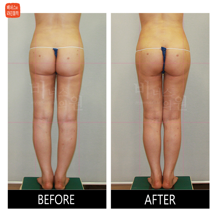 reoperation liposuction of thighs and buttocks_8.jpg