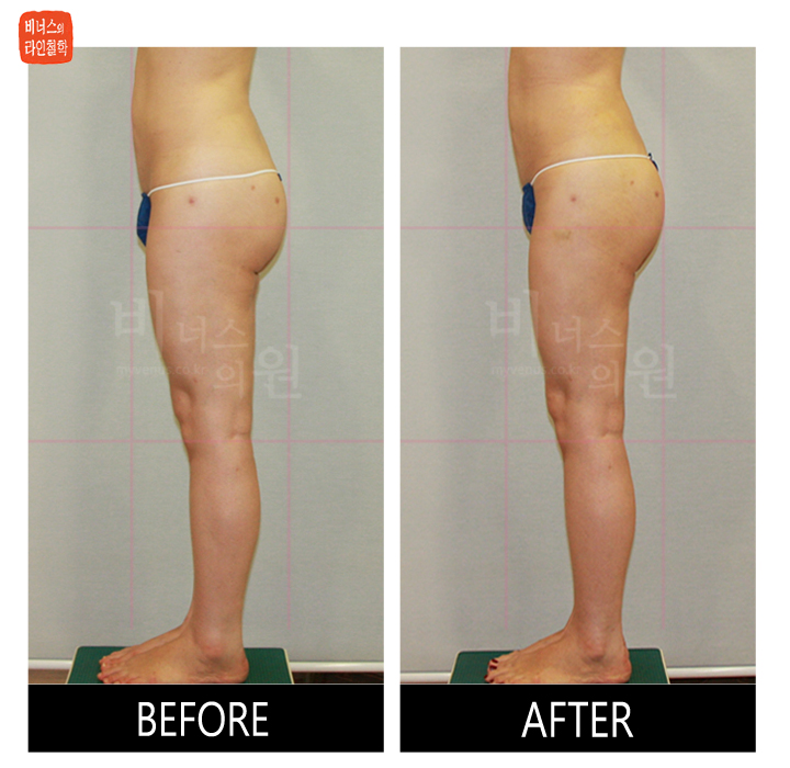 reoperation liposuction of thighs and buttocks_10.jpg
