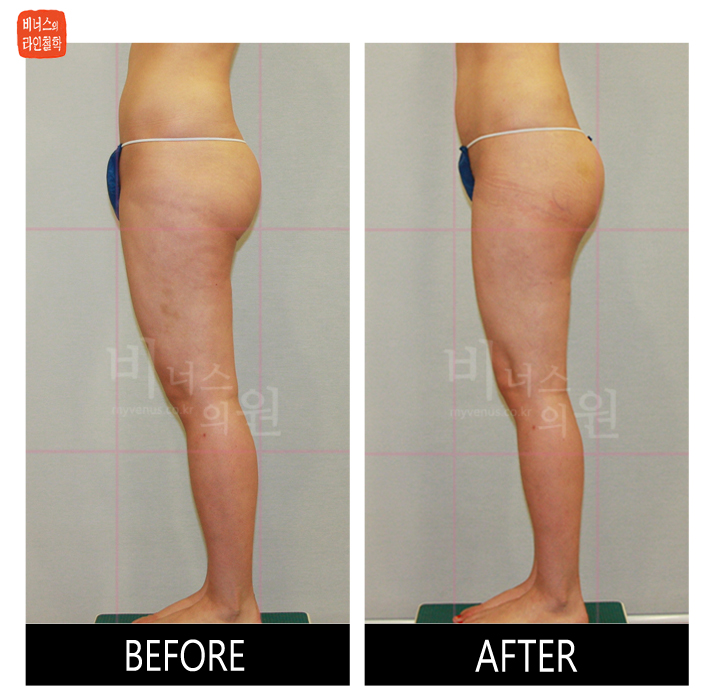 reoperation liposuction of thighs and buttocks_13.jpg