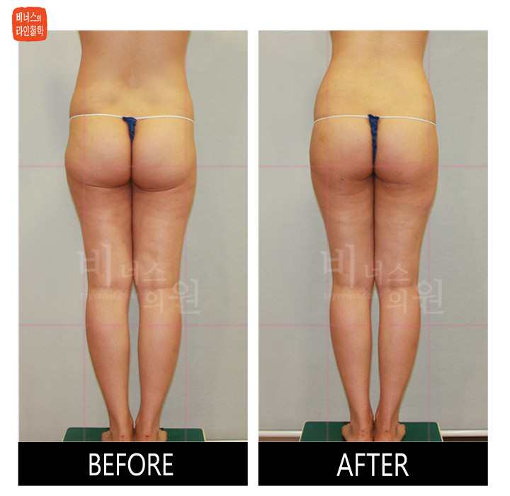 reoperation liposuction of thighs and buttocks_11.jpg