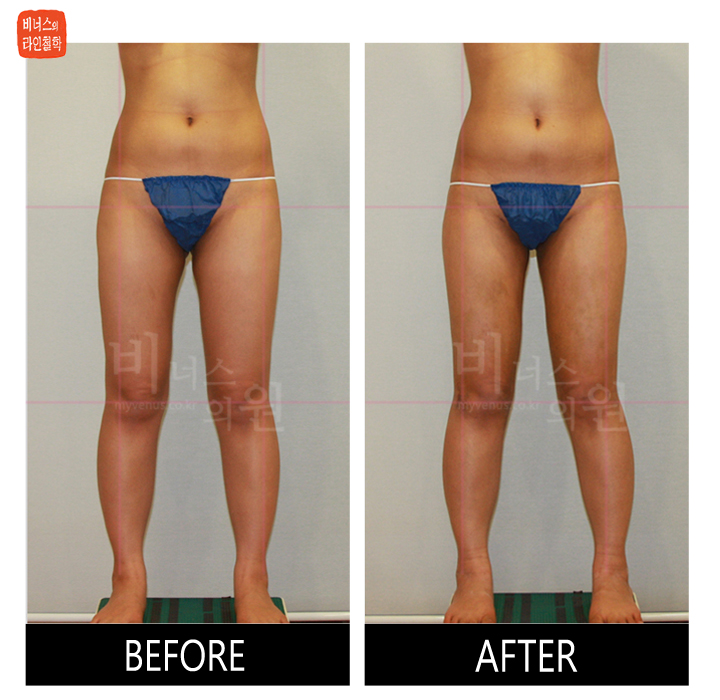 reoperation liposuction of thighs and buttocks_3.jpg