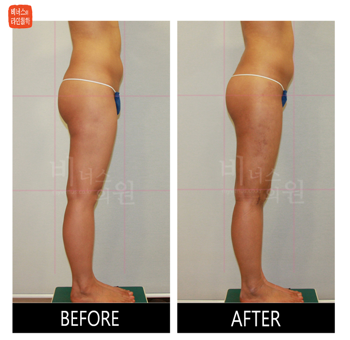 reoperation liposuction of thighs and buttocks_7.jpg