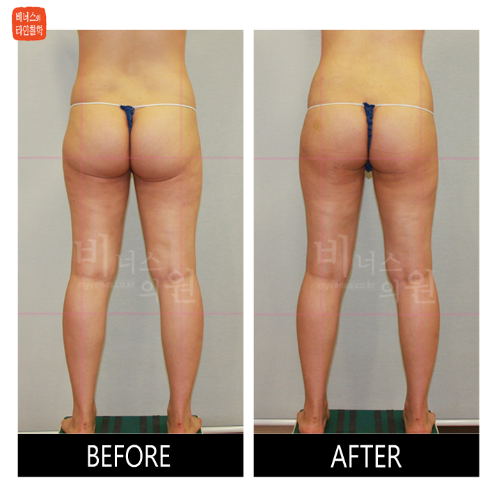 reoperation liposuction of thighs and buttocks_12.jpg
