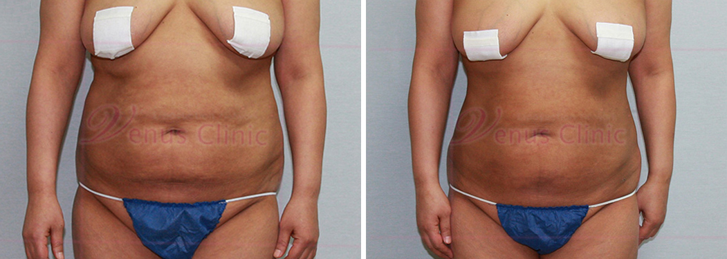 reoperation liposuction d/t insufficient fat removal-1.jpg