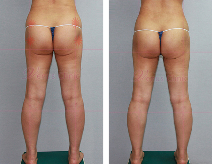 reoperation liposuction of arms-3.jpg
