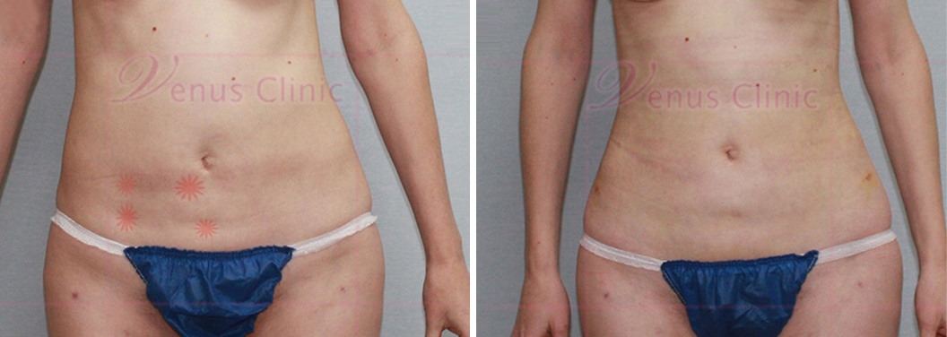 reoperation liposuction of abdomen-4.jpg