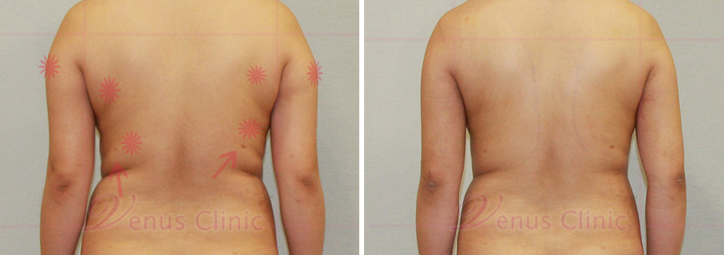 reoperation liposuction of arms-2.jpg
