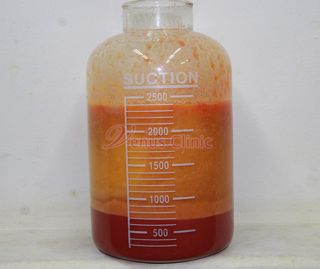 aspirated fat by reoperation liposuction