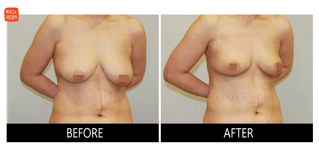 liposuction for breast reduction3