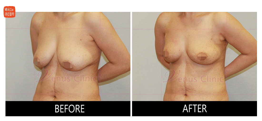liposuction for breast reduction3