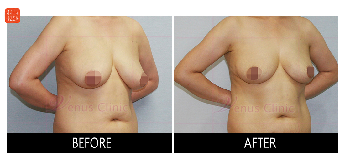 liposuction for breast reduction2