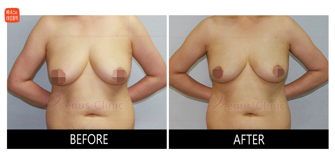 liposuction for breast reduction2