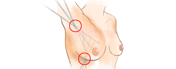 liposuction for breast reduction-1.jpg