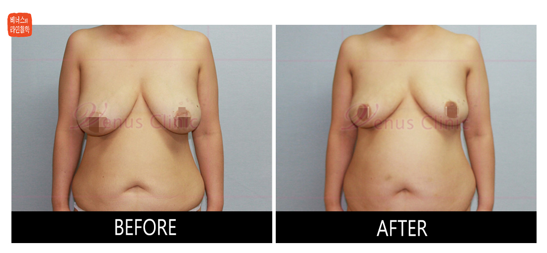 liposuction for breast reduction5