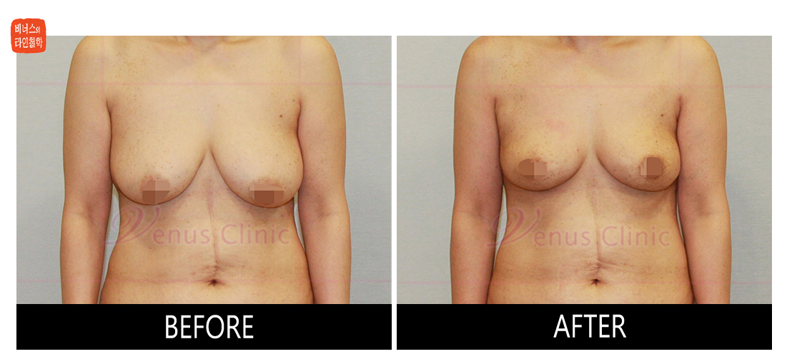 liposuction for breast reduction3