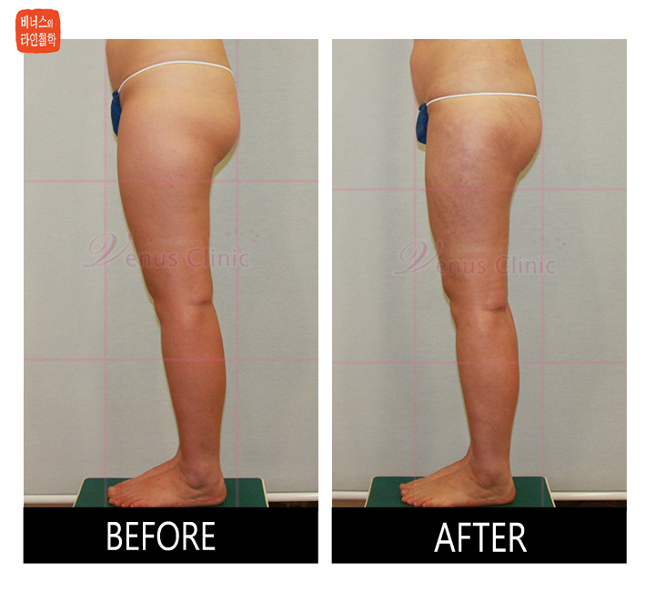 buttocks liposuction7_0.jpg