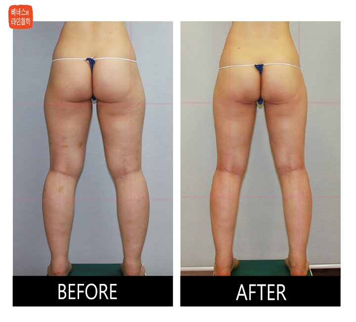 buttocks liposuction2.jpg