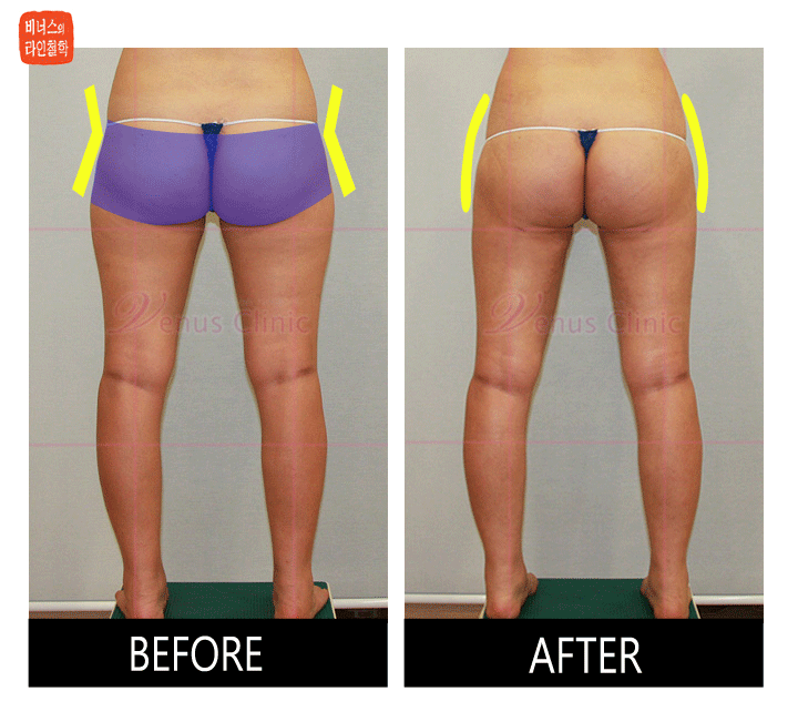 buttocks liposuction1.gif