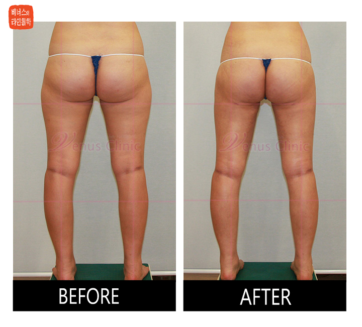 buttocks liposuction7.jpg
