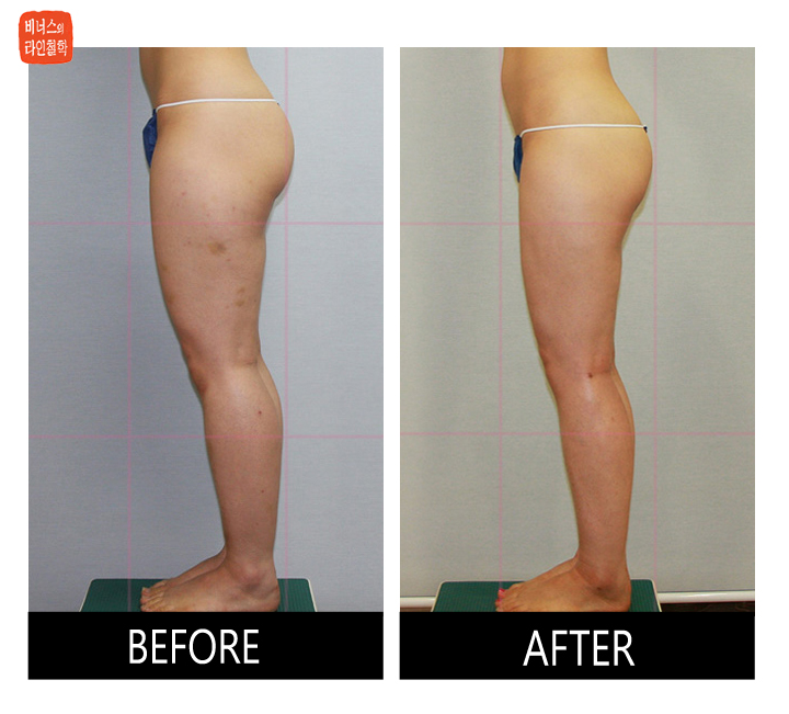 buttocks liposuction1.jpg